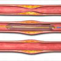 balloon-angioplasty-artery