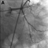 stent-post-dilatation-nc-clever-ptca-balloon-catheterA