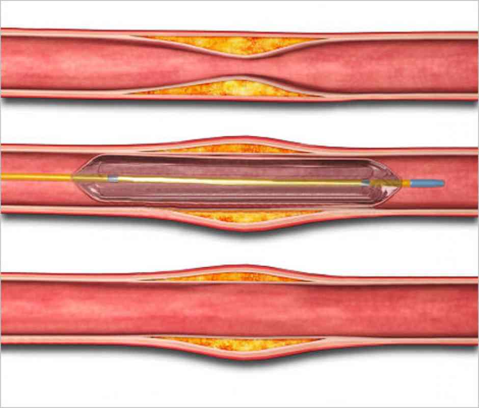 balloon-angioplasty-artery